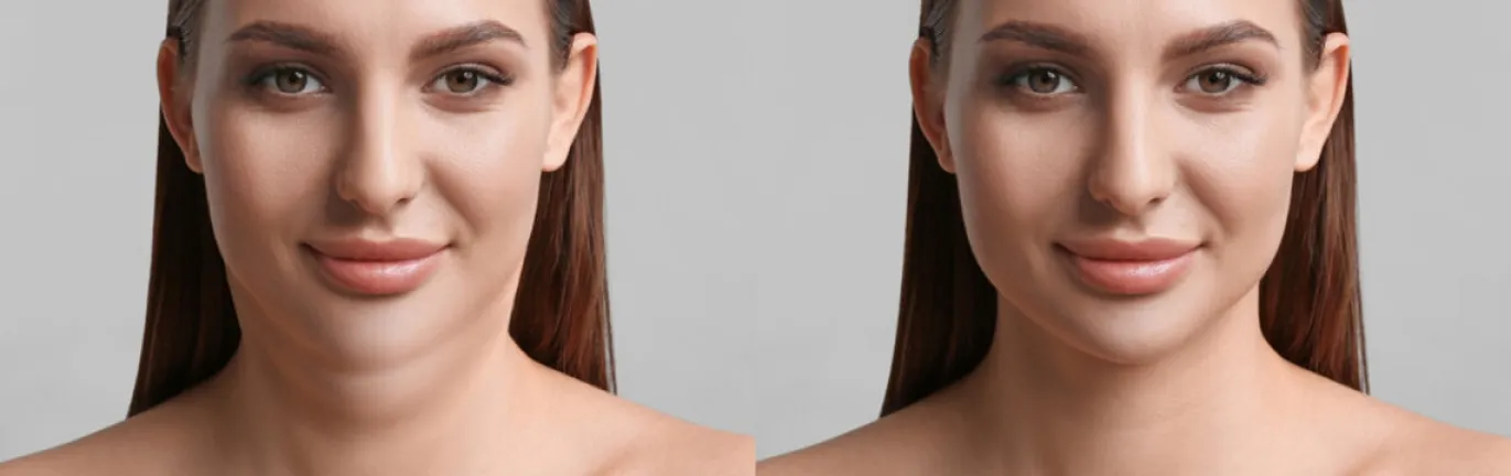 Kybella Before And After Pictures