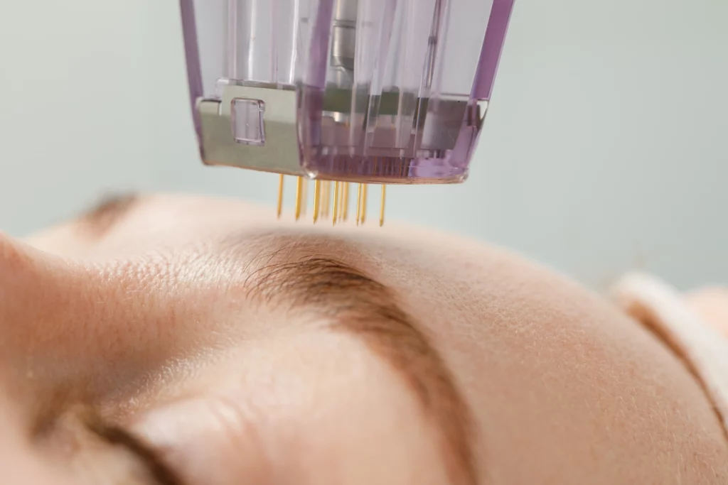 a person getting a laser treatment