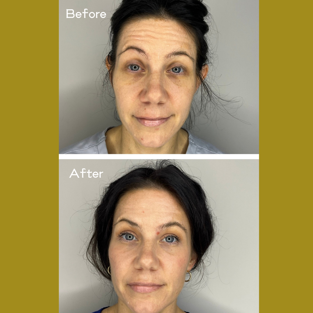 Botox before and after.1