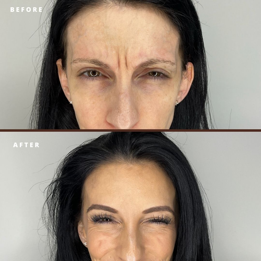 Botox before and after.4