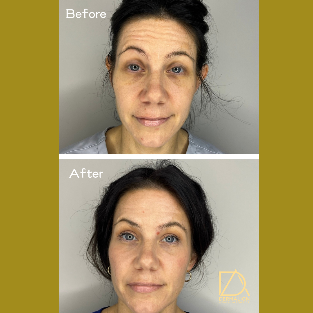 Botox 1