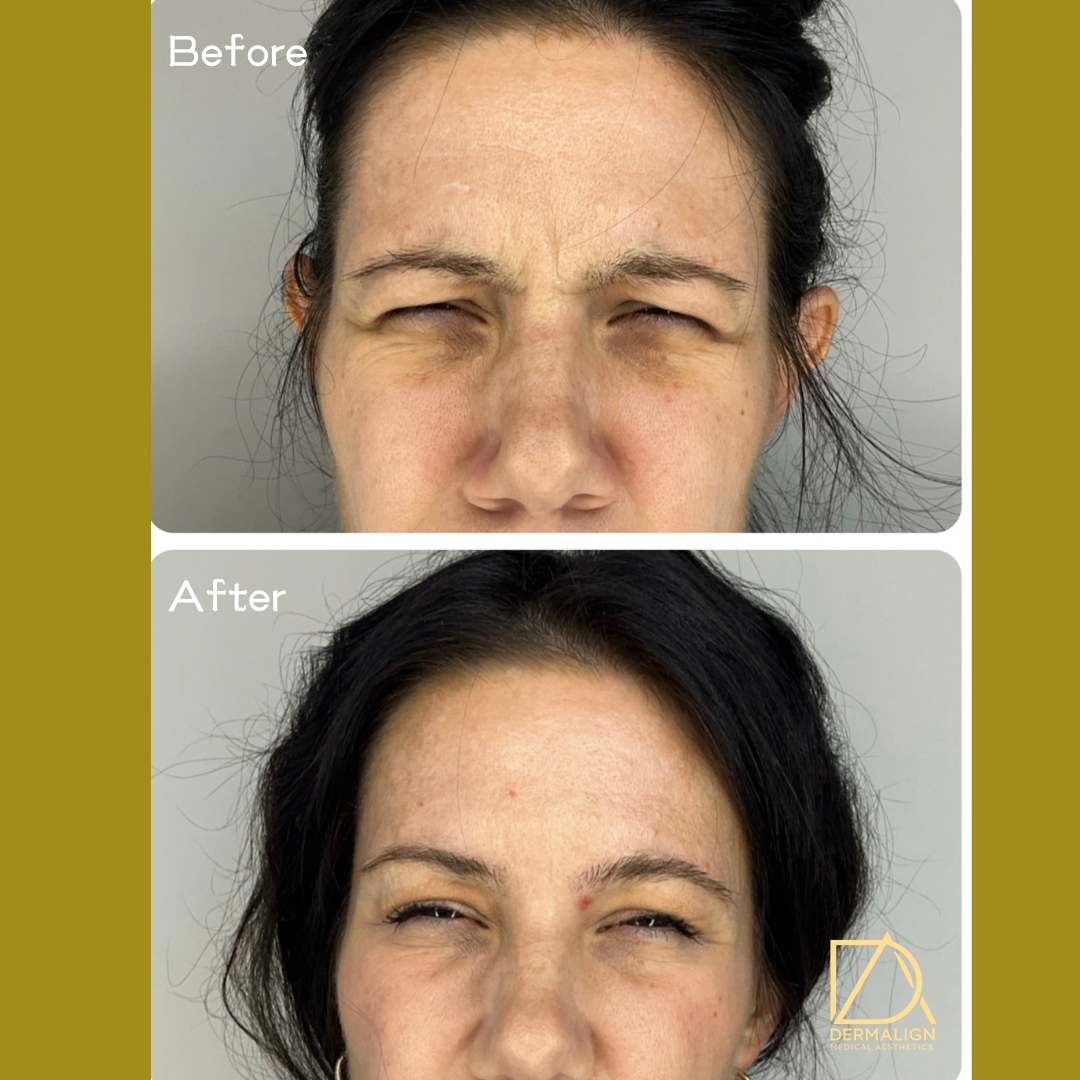 Botox 2