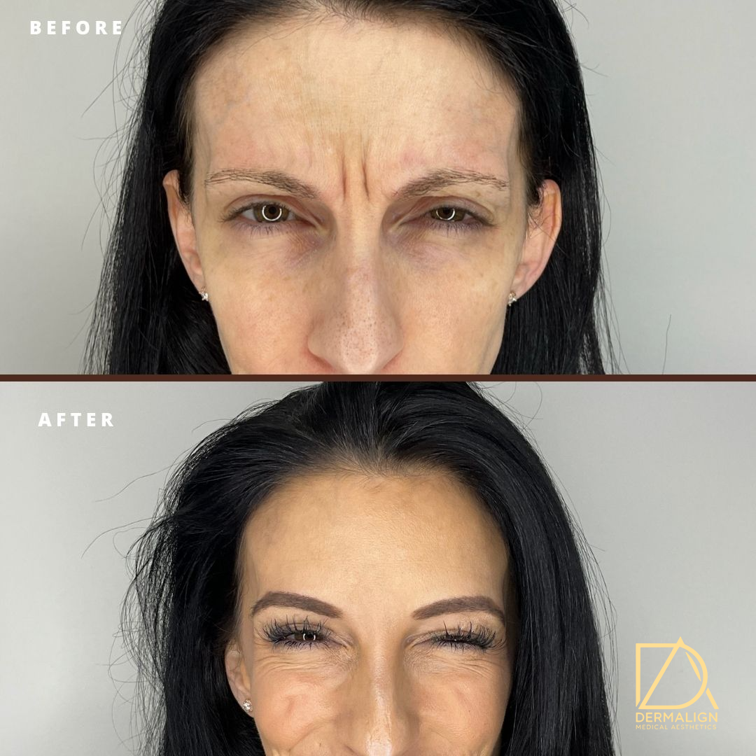 Botox 3
