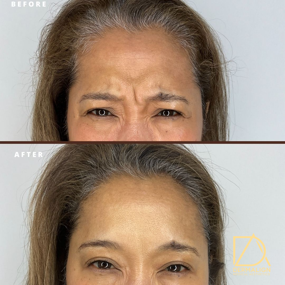 Botox 4