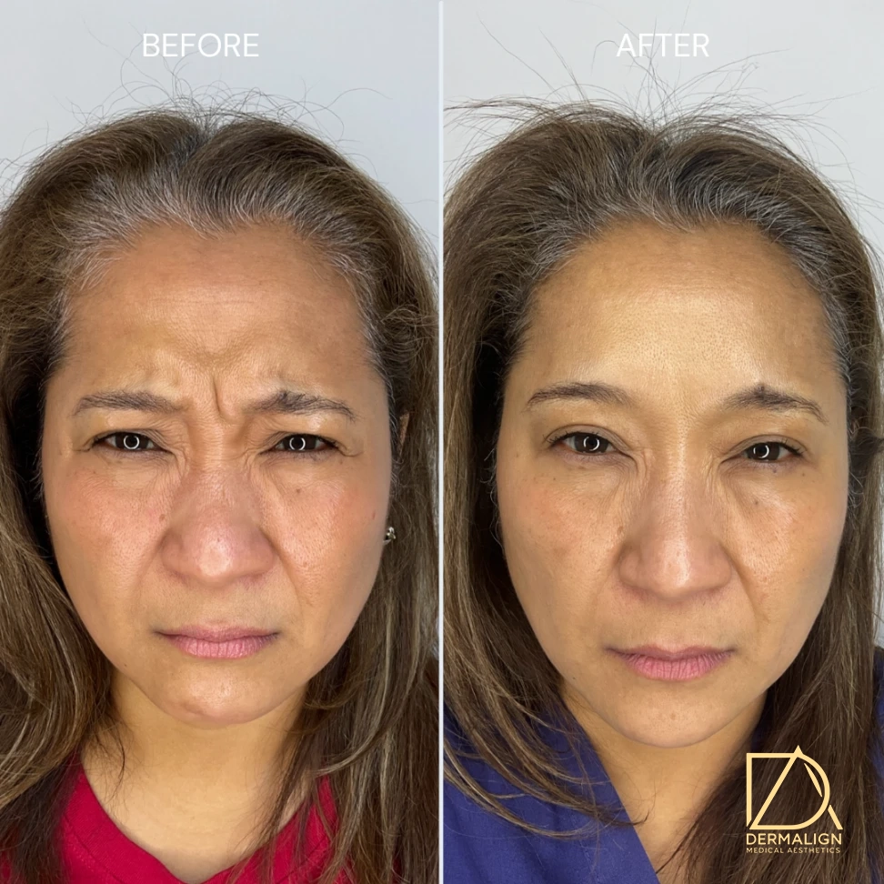 Botox 5