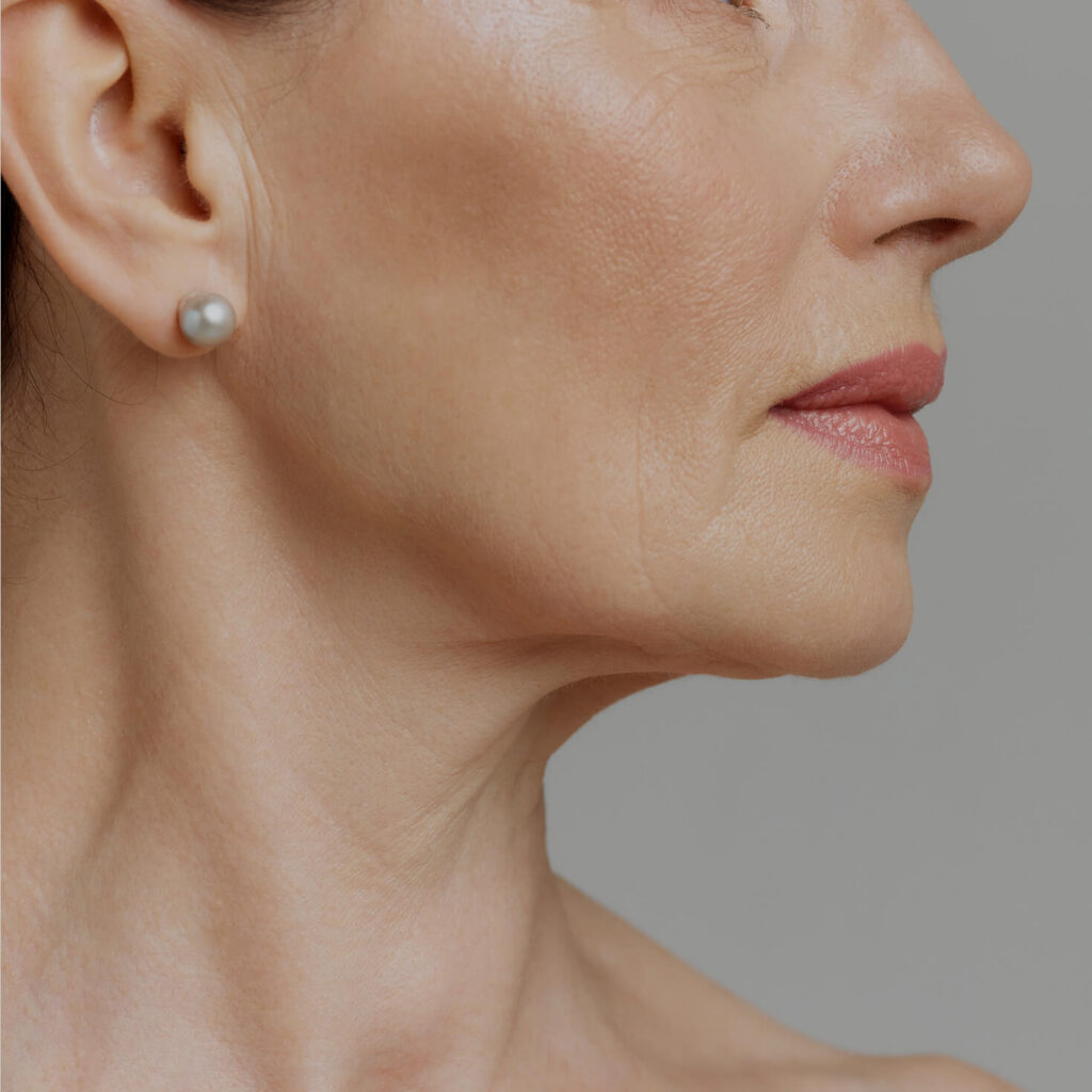 Kybella image 1