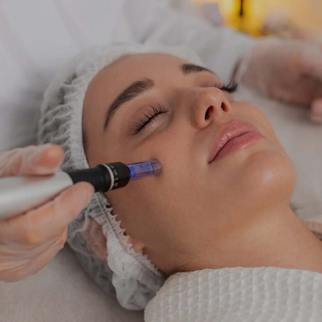 Microneedling with PRP 2