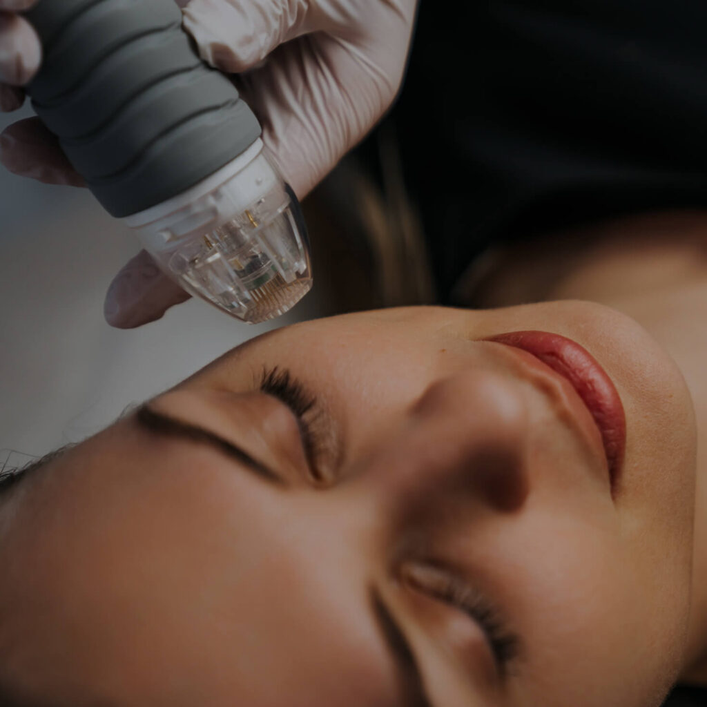 Microneedling without PRP 1