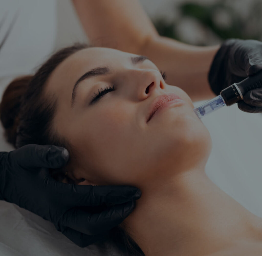 Microneedling