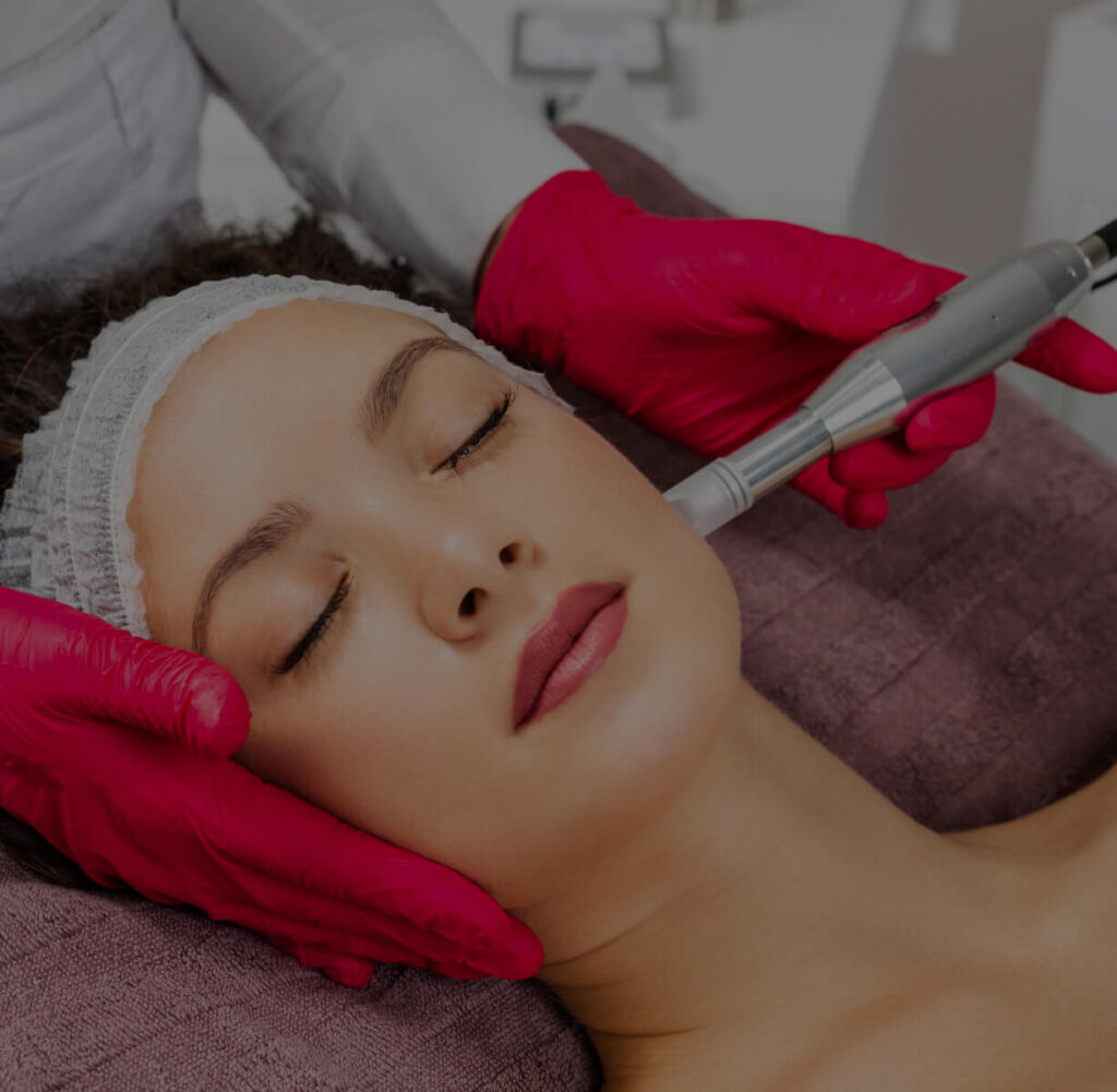 Microneedling with PRP